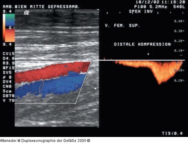 Duplexsonographie - Kompression