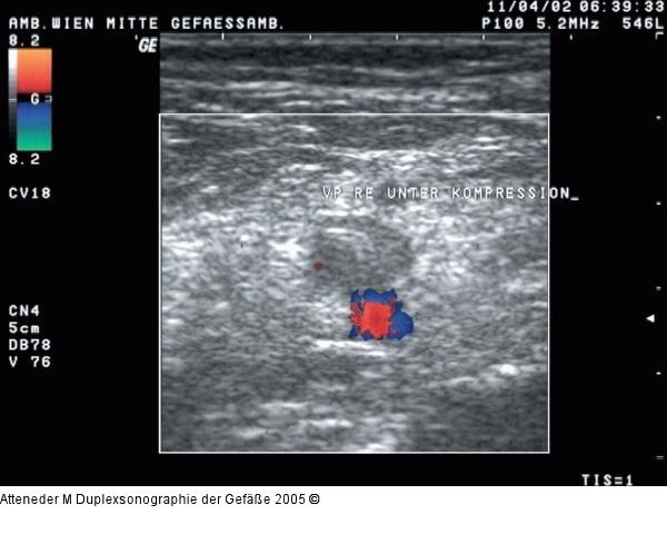 Duplexsonographie - V. poplitea - Kompression