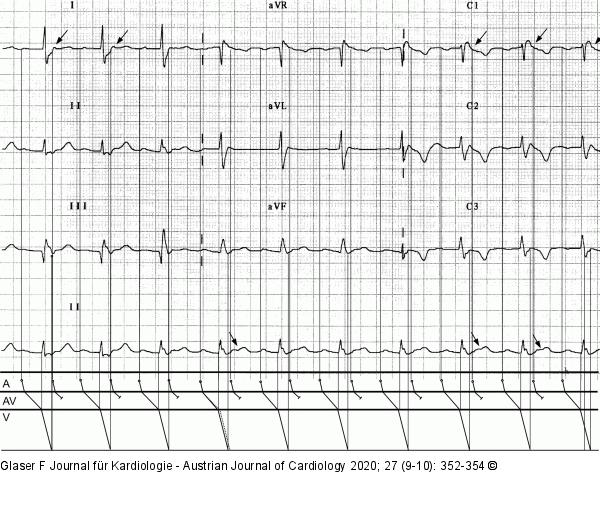 Ruhe-EKG