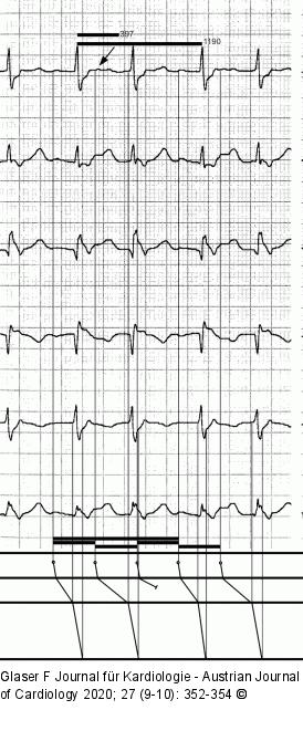 Belastungs-EKG – Leiterdiagramm