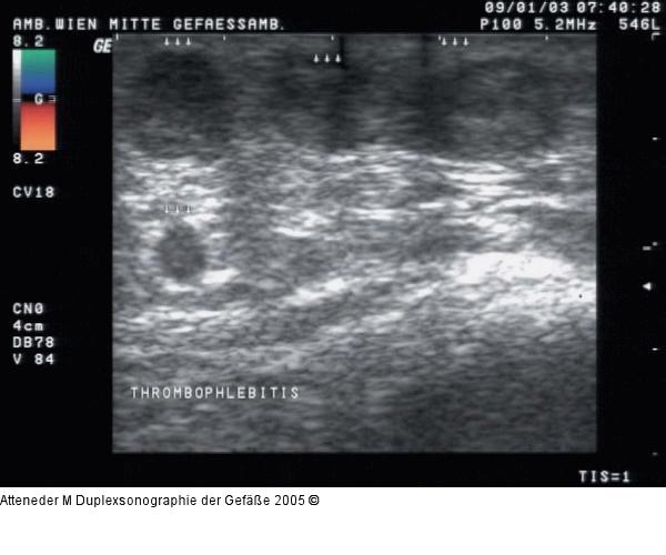 Duplexsonographie - Thrombophlebitis