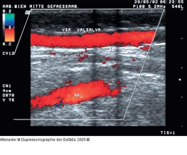 Duplexsonographie - insuffiziente V. saphena parva