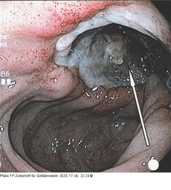  Duodenum