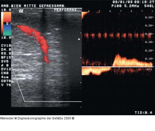 Duplexsonographie - Perforansinsuffizienz