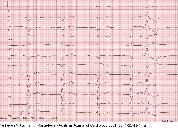 EKG