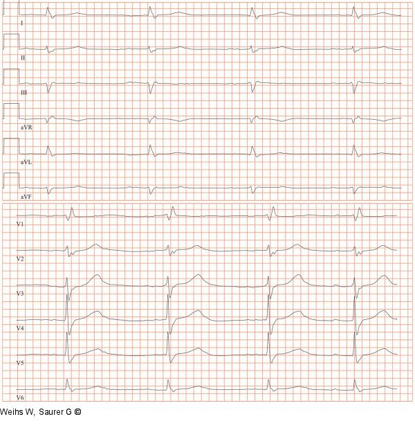 EKG
