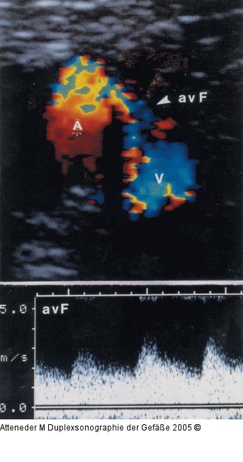 Duplexsonographie - AV-Fistel