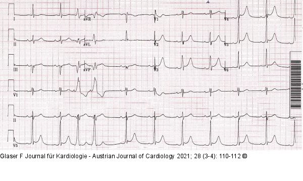EKG