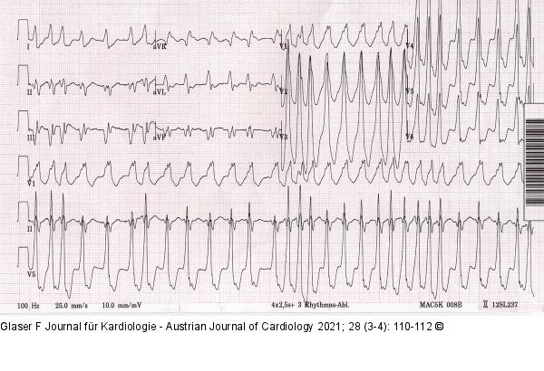 EKG
