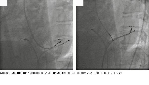 Ablation