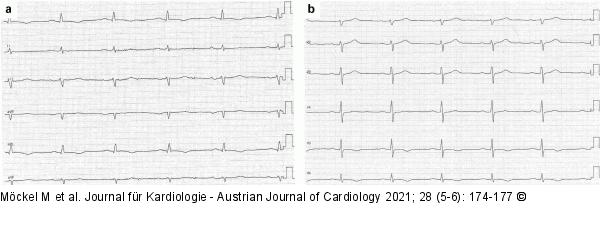 EKG