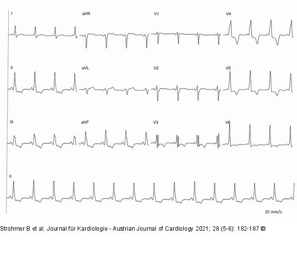 EKG