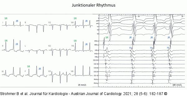JR - EKG
