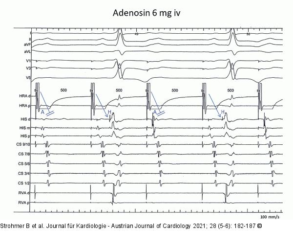 Adenosin-Test