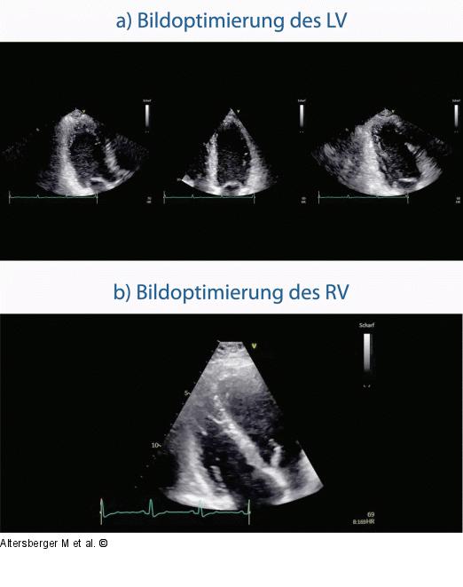 B-Bildoptimierung - LV