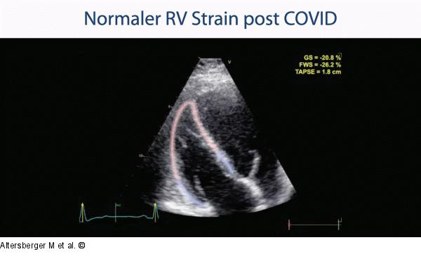 RV-Strain