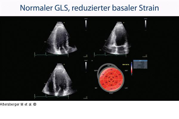 GLS - LV