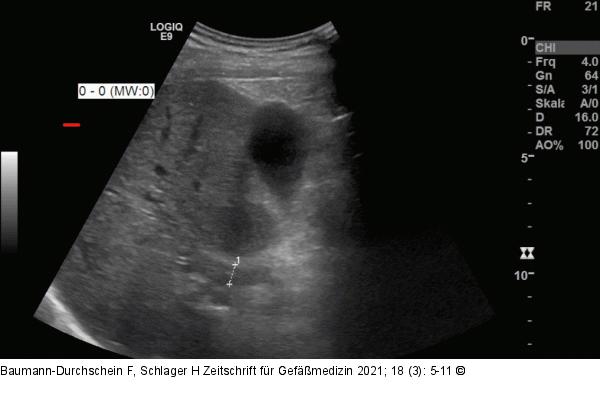 Pfortaderthrombose
