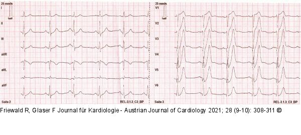 EKG