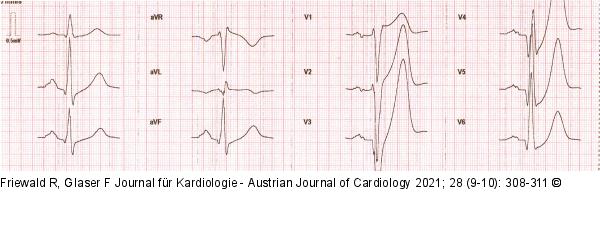 EKG