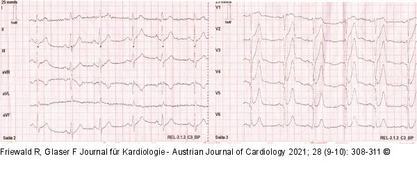 EKG