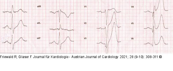 EKG