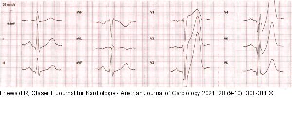 EKG