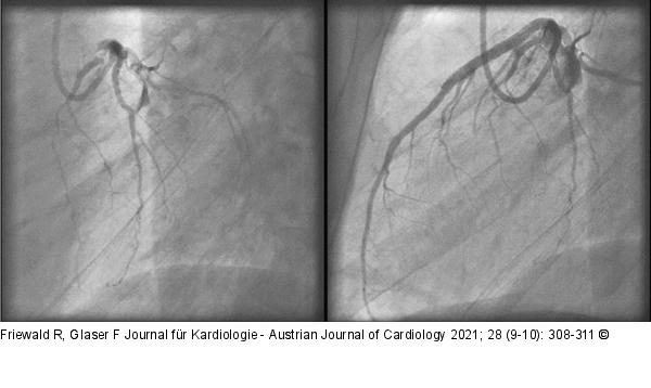 Thrombose
