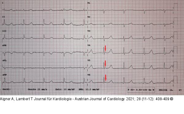 EKG
