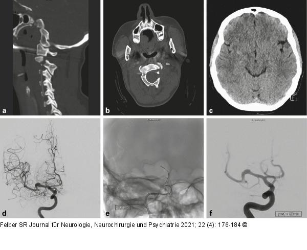 Dissektionsaneurysma