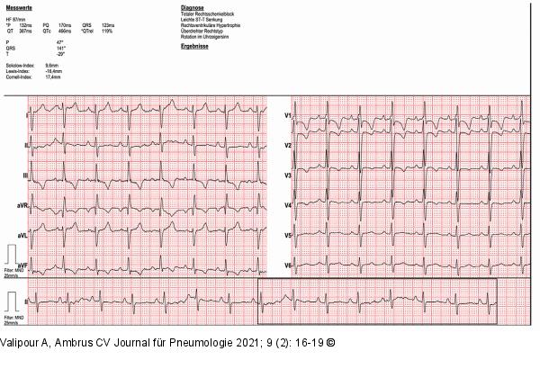 EKG