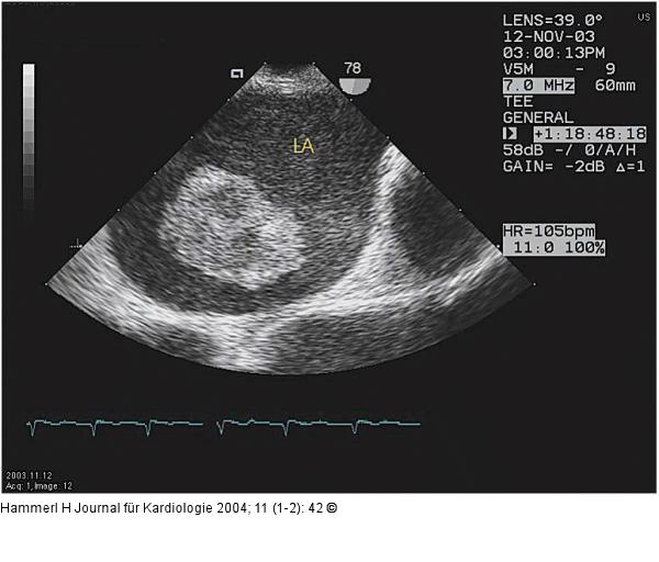 Gestielter Vorhofthrombus
