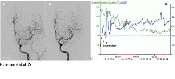 Intra-arterielle Spasmolyse