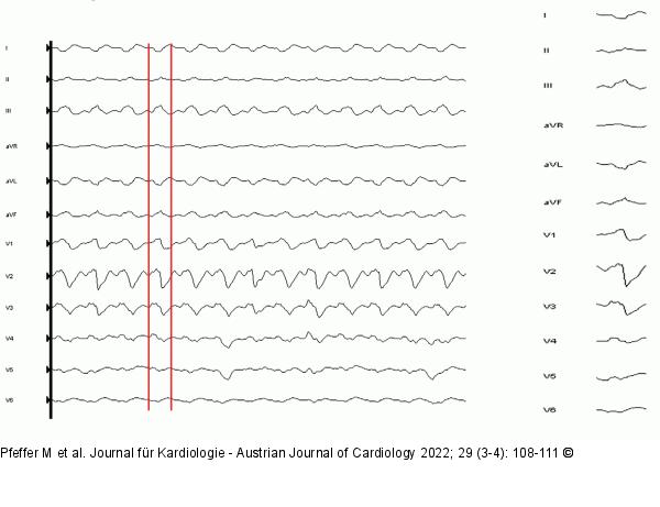 Oberflächen-EKG