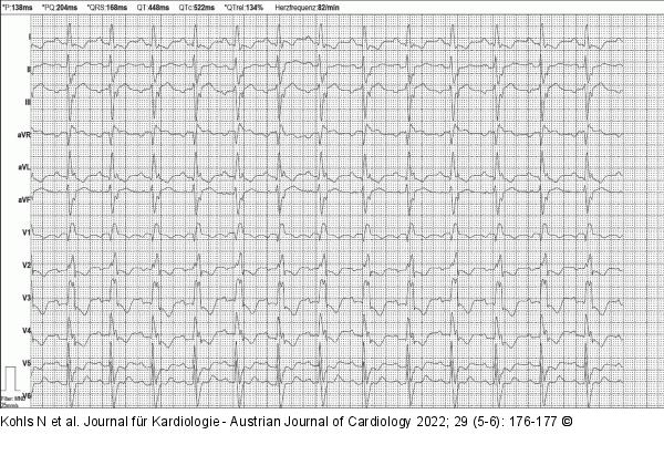 EKG