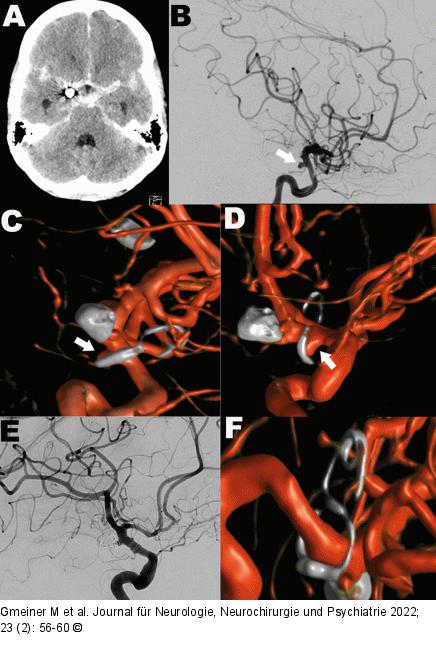 Aneurysma