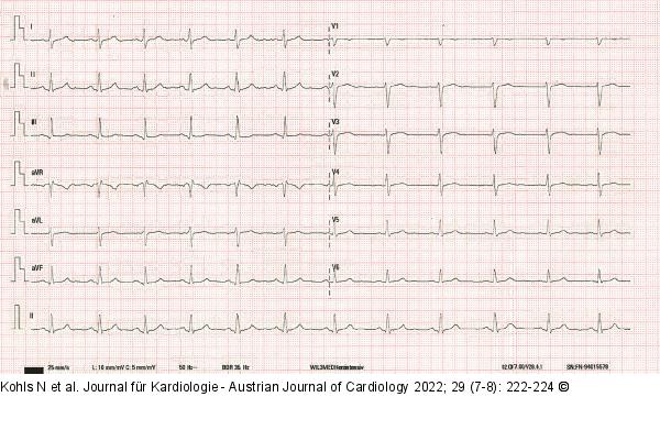 EKG