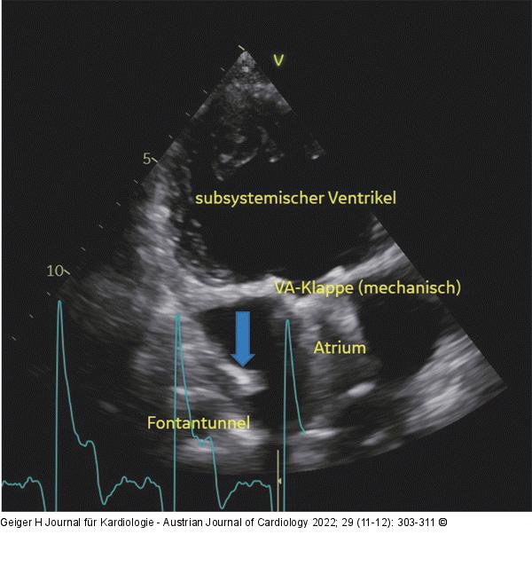 Single Ventricle