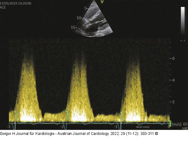 CW-Doppler - VSD