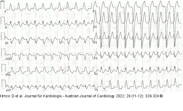EKG