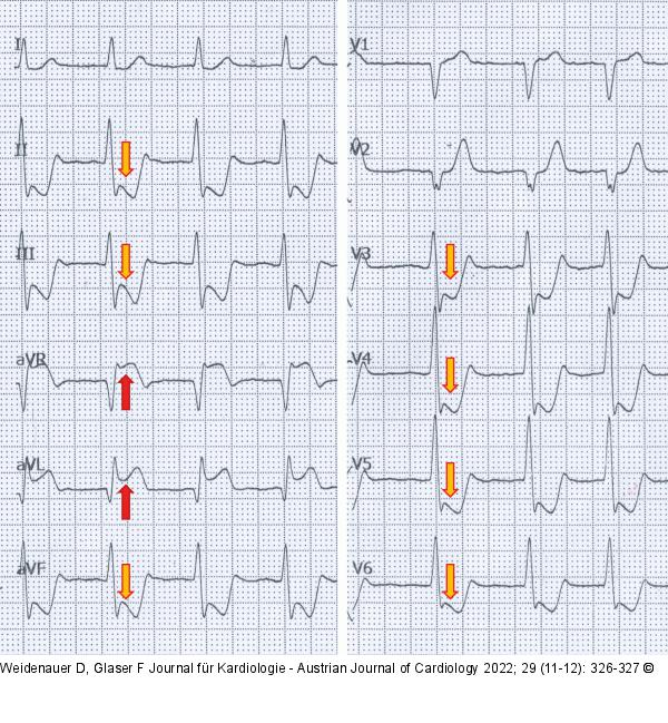EKG