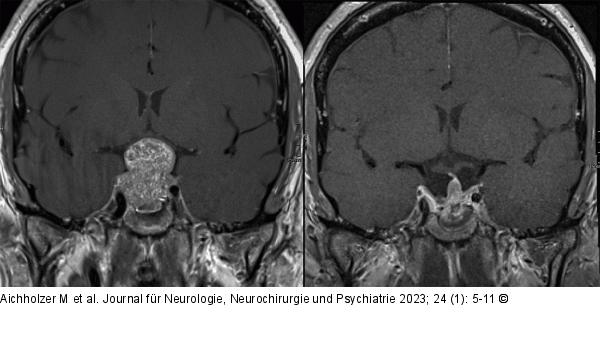 Hypophysenchirurgie