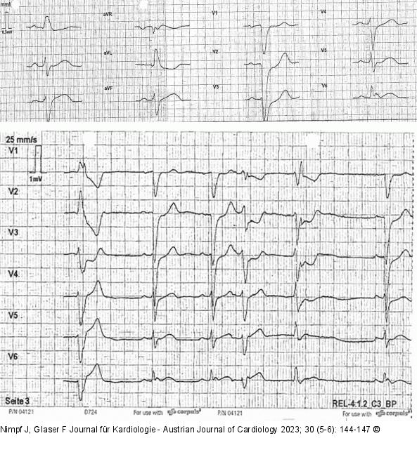 EKG