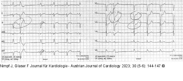 EKG