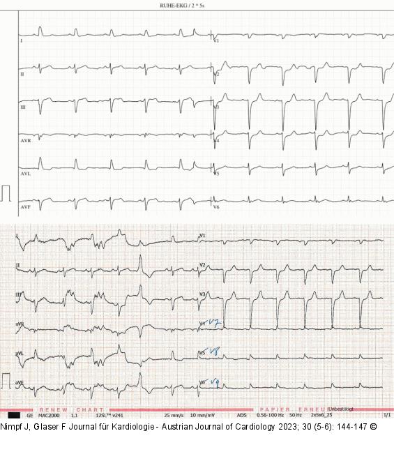 EKG