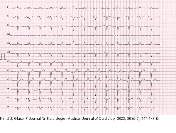 EKG