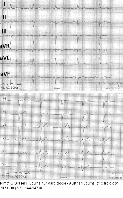 EKG