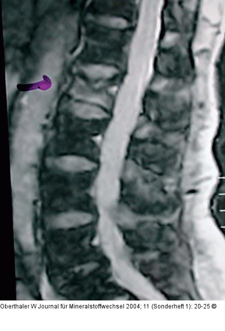 Vertebroplastie