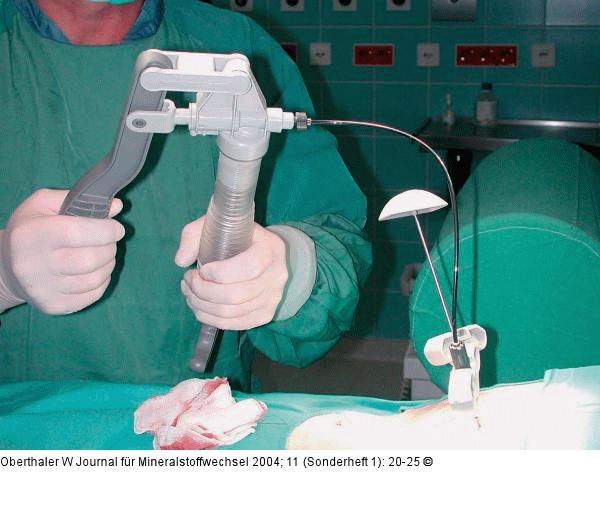 Vertebroplastie