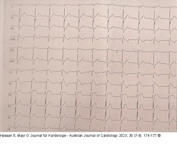 EKG